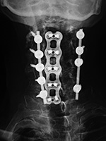 Anterior and cervical spine fusion with intervertebral bone struts